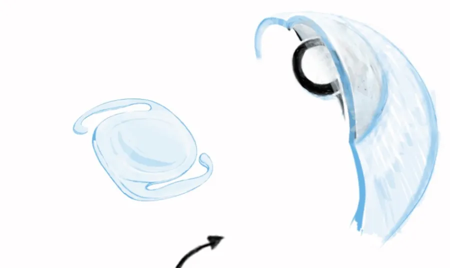 Lenti intraoculari ICL